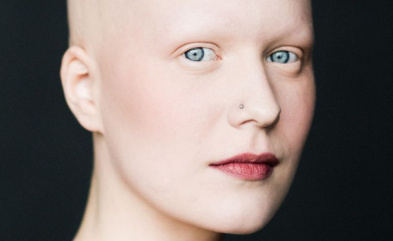 L'alopecia